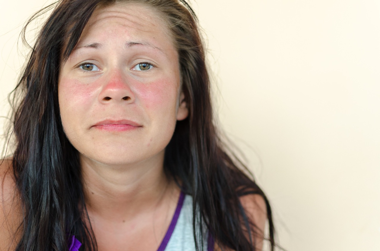 rosacea-ruzovka-podrazdena-plet-bio