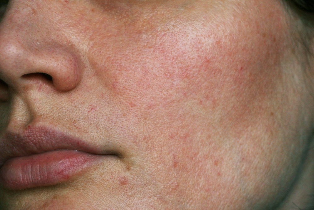 ruzovka-rosacea-blissoma-prirodni-pece-o-plet-bio