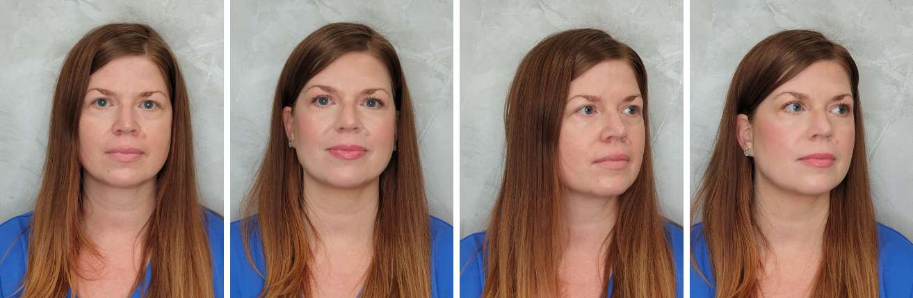 pred_a_po_kosmeticke_osetreni_lucie_liceni